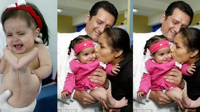 Seorang Bayi Lahir dengan Bagian Kaki Mirip Putri Duyung