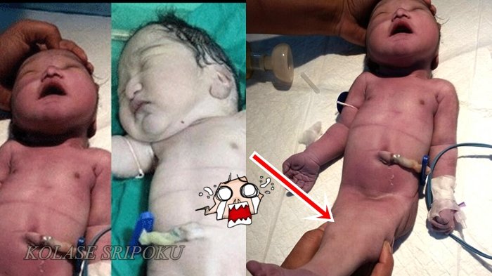 Melahirkan Bayi 'Putri Duyung'. Wanita Ini Menangis Saat Dokter Ungkap Kesalahannya Ketika Hamil