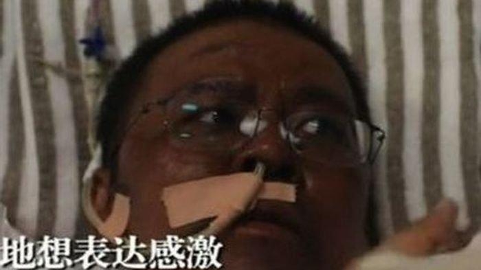 Kisah Dokter Hu di China Kulitnya Menghitam Itu Meninggal Karena Covid-19,  Terungkap Ada Pendarahan