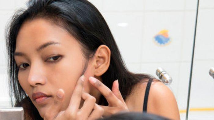 3 Hal Pemicu Timbulnya Jerawat di Wajah