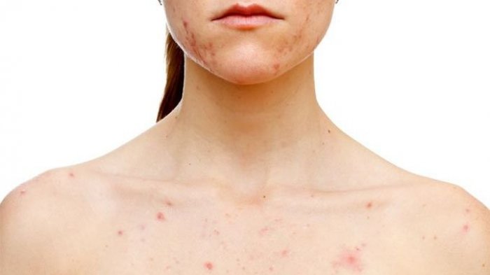 Jerawat di Dada Bikin Nggak Nyaman? Atasi Dengan Buah Ini, Praktis Banget!