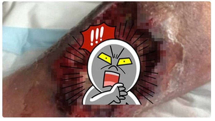 Kasihan! Gatal Lalu Digaruk, tak Disangka Selang Beberapa Hari Kaki Kakek Ini Jadi 'Berlubang Parah'