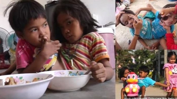 Dempet Sejak Lahir, Bocah Kembar Siam Ini tak Mau Dipisahkan
