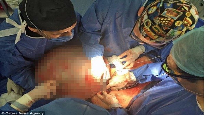 Sedang Diet Ketat Perut Gadis Ini Malah Membesar 10 x  Lipat, Dokter pun Terpaksa Lakukan Ini