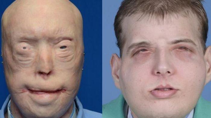 Mantan Pemadam Kebakaran Ini jadi Penerima Cangkok Wajah Terbanyak