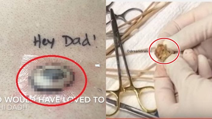 Dokter Ini Kembali Lakukan Aksi Gila, Lihat yang Dikeluarkan Dari Punggung Pria Ini, Bikin Mual