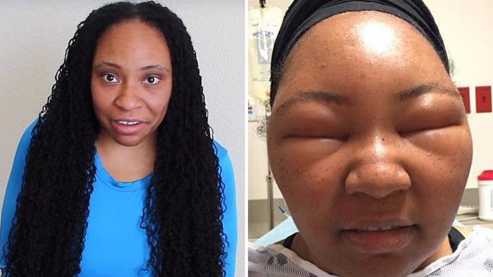 Mewarnai Rambut di Salon, Wanita Ini Terkejut dengan yang Terjadi Pada Wajahnya