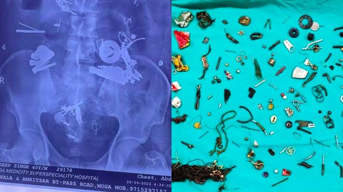 Hasil-rontgen-menunjukkan-150-benda-asing-di-perut-seorang-pria-di-Rumah-Sakit-India.jpg