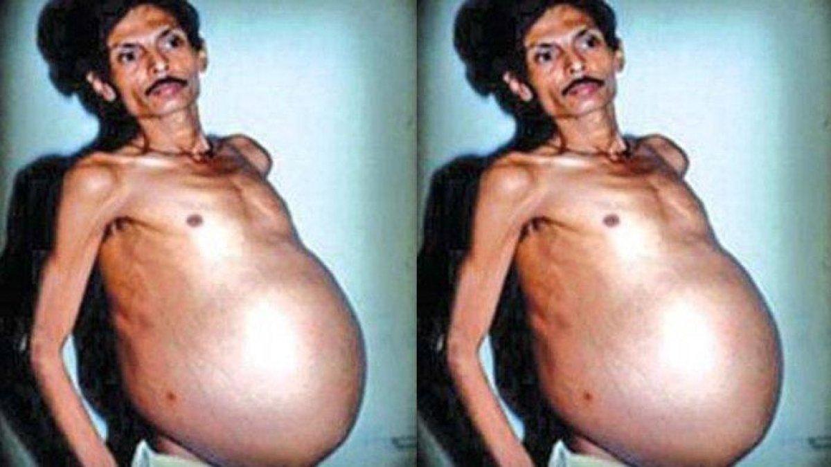 Kisah-pria-di-India-perut-membesar-bak-sedang-hamil.jpg