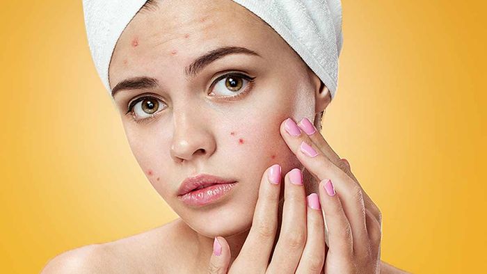 flek-di-wajah-jerawat.jpg