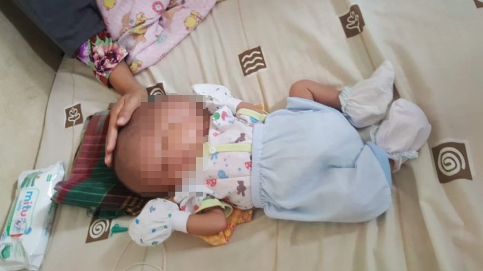 Bayi Kembar Siam Lahir Dengan Dua Muka dan Satu Badan, Begini Kondisinya Sekarang