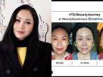 Transformasi-Wajah-Baru-Titi-DJ-Pasca-Operasi.jpg