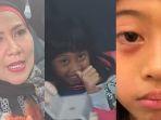 Kondisi Mata Anak Venna Melinda Membaik, Sebelumnya Bengkak akibat Dilempar Serpihan Rubber