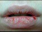 bibir-kering-dan-pecah-pecan.jpg