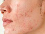bopeng-bekas-jerawat.jpg