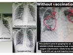 dokter-anne-gabriel-chan-tunjukkan-hasil-x-ray-pasien-yang-sudah-dan-belum-divaksin-covid-19-1.jpg