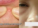 kebiasaan-pencet-jerawat-pria-ini-nyaris-tewas-dan-alami-koma.jpg