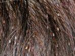 kutu-rambut.jpg