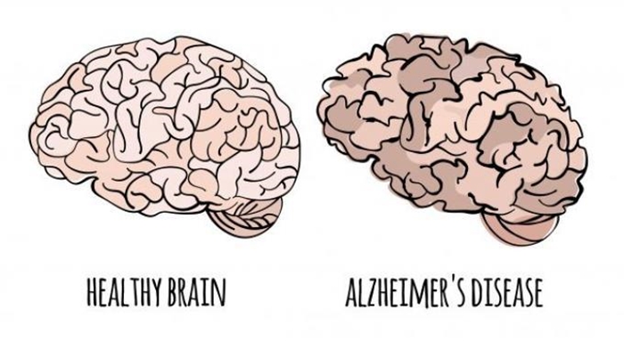 ilustrasi-alzheimer.jpg