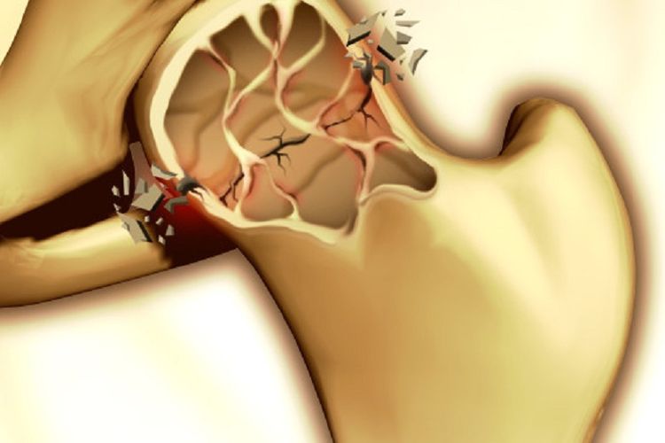 tulang-terkena-osteoporosis-sendi.jpg