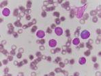 ilustrasi-sel-darah-pada-leukemia-tipe-aml.jpg