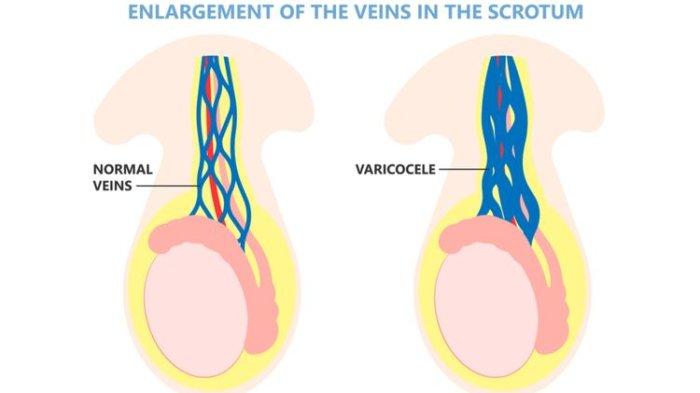 Apa Itu Penyakit Varikokel, Seperti Apa? Inilah Penyebab, Gejala Hingga Perawatannya
