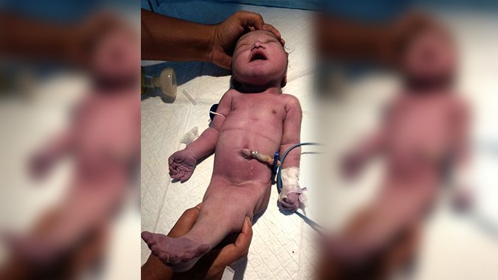 Hanya Bertahan 4 Jam, Bayi Ini Terlahir Seperti Putri Duyung,Saat Hamil Ternyata Ibu Tak Lakukan Ini