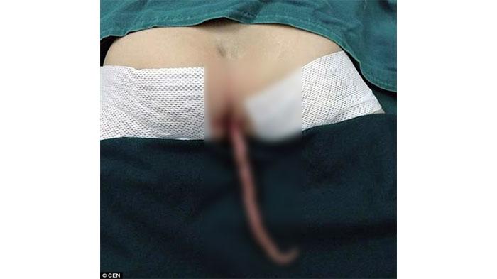 Keluarga Mengira 'Ekor' Itu Pertanda Keberuntungan Bagi Bayi, Ternyata di Luar Harapan