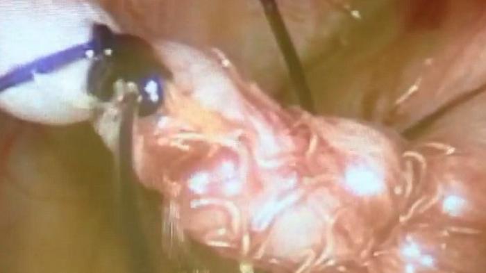 BAB Berdarah? Bisa Jadi Gejala Kanker Usus Besar