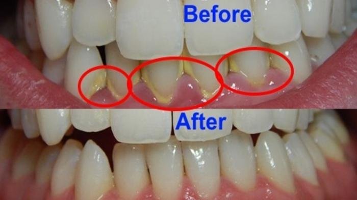 Obat Tradisional Bersihkan Karang Gigi di Rumah, Cukup Pakai Bahan-bahan Alami Ini Saja