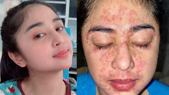 Curhat Dewi Perssik: Aku Sakit Kena Covid-19, Aku Tidak Jadi Pembunuh, Netizen: Ngeri Juga Ya