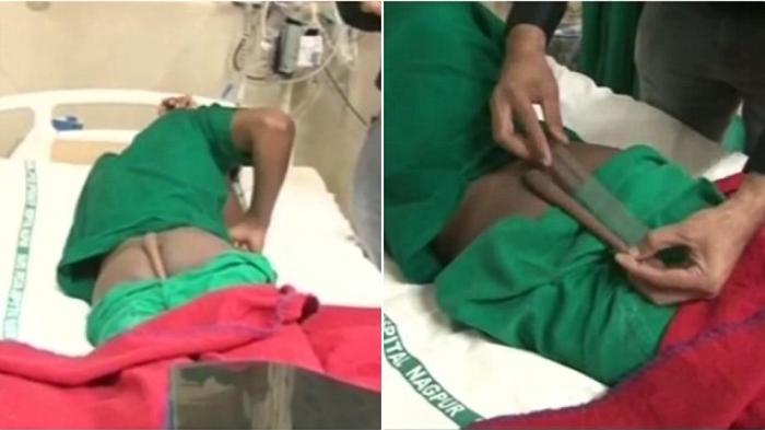 Sakit Saat Duduk dan Berbaring, Dokter Potong Bagian Sepanjang 18 Cm dari Punggung Bawah Remaja Ini