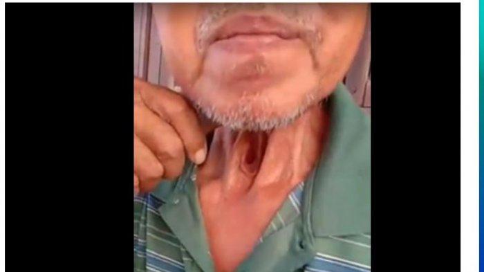 Fakta Video Tenggerokan Berlubang Seorang Bapak Gara-Gara Rokok, Perubahan Suara dan Kata Dokter!
