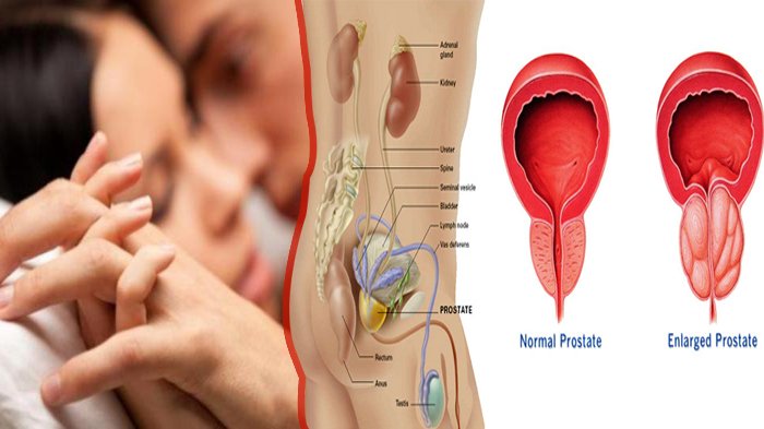 Kanker Prostat Incar Pria Bertubuh Jangkung