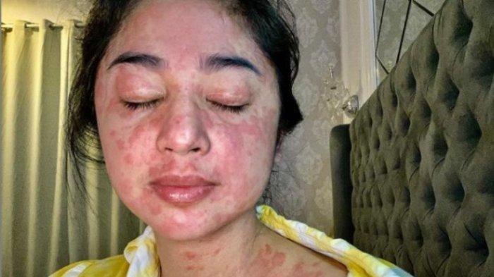 Kabar Buruk dari DP, Wajah & Tubuhnya Memerah, Ternyata Dewi Perssik Positif Covid-19 (Virus Corona)