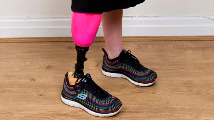 Senang Kakinya Diamputasi, Gadis Ini Rela Keluarkan Biaya Mahal