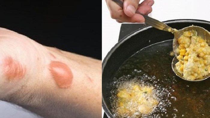 Kulit Melepuh Kena Minyak Goreng Panas? Obati dengan Bahan Alami Ini, Jadi Mulus Lagi