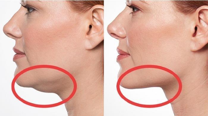 Hilangkan Lemak Dagu dalam 6 Hari Pakai 5 Bahan Alami Ini, Mudah Tapi Ampuh
