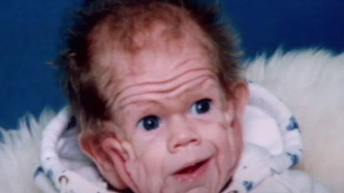 Mukjizat Yang Maha Kuasa Luar Biasa, Anak Ini Dulu Lahir Kriput Seperti Kakek-kakek, Kini Ia Tampan