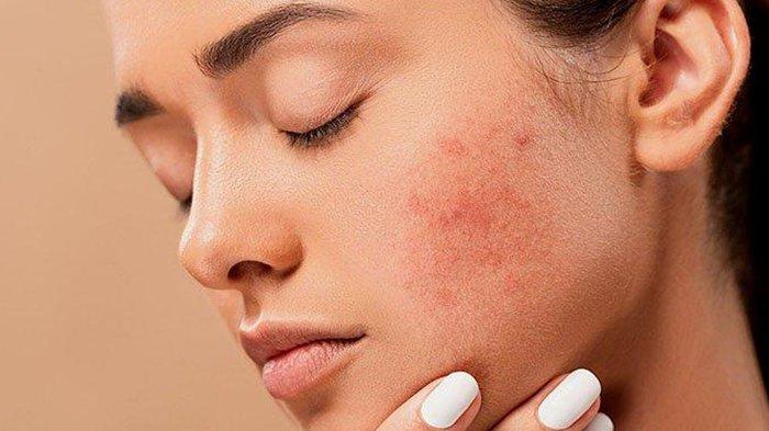 Tak Hanya Obati Jerawat , Benda yang Tak Disangka sangka Ini Ternyata juga bisa Cegah Kanker