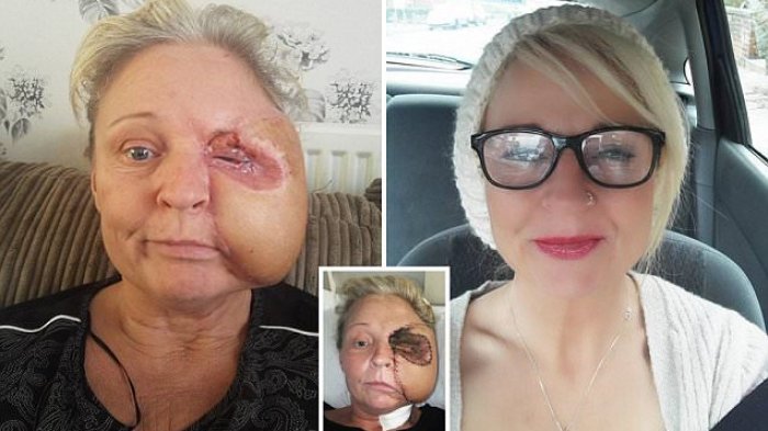 Mengerikan! Terbentur dan Pingsan, Setengah Wajah Wanita ini Digerogoti Serangga Langka