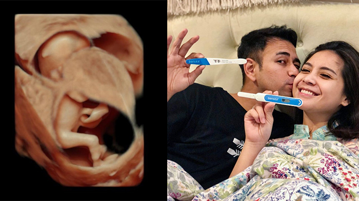 Raffi Ahmad dan Nagita Slavina Umumkan Jenis Kelamin Anak Kedua, Begini Potret USG Sang Bayi