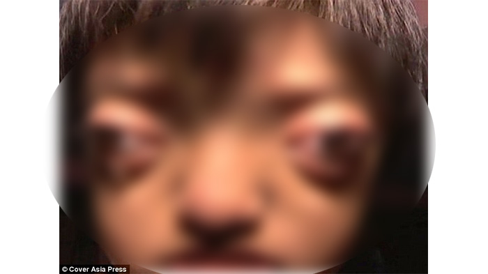 Diejek Seperti 'Kodok' dan 'Alien' Bocah Ini Terpaksa Berhenti Sekolah