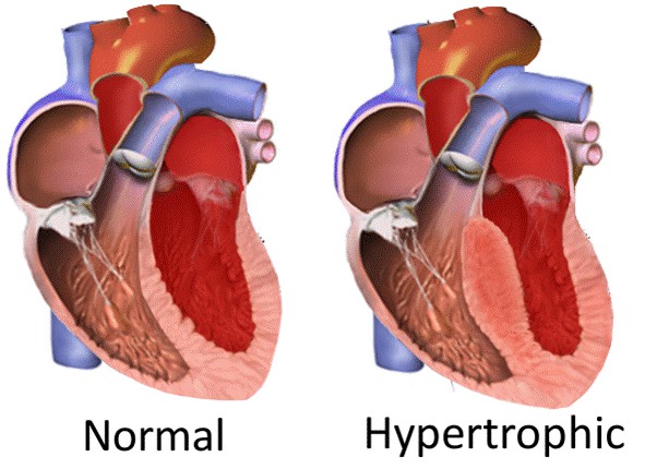 kardiomiopati-hipertrofik-dengan-jantung-normal_20160317_194520.jpg