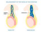 Ilustrasi-Varikokel.jpg