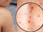 Ilustrasi_Monkeypox_Mpox_29082024.jpg