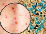Ilustrasi_Monkeypox_Mpox_29082024_2.jpg
