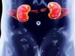 batu-ginjal.jpg