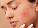 tak-hanya-obati-jerawat-benda-tak-disangka-ini-juga-cegah-kanker.jpg