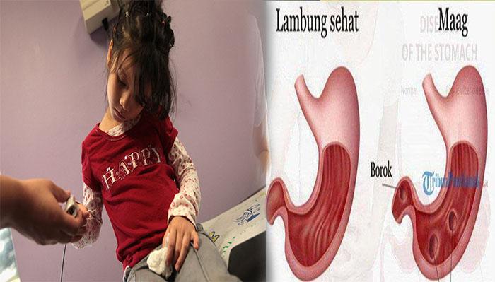 Bahaya-Sakit-Asam-Lambung-yang-Menyerang-Anak-anak.jpg
